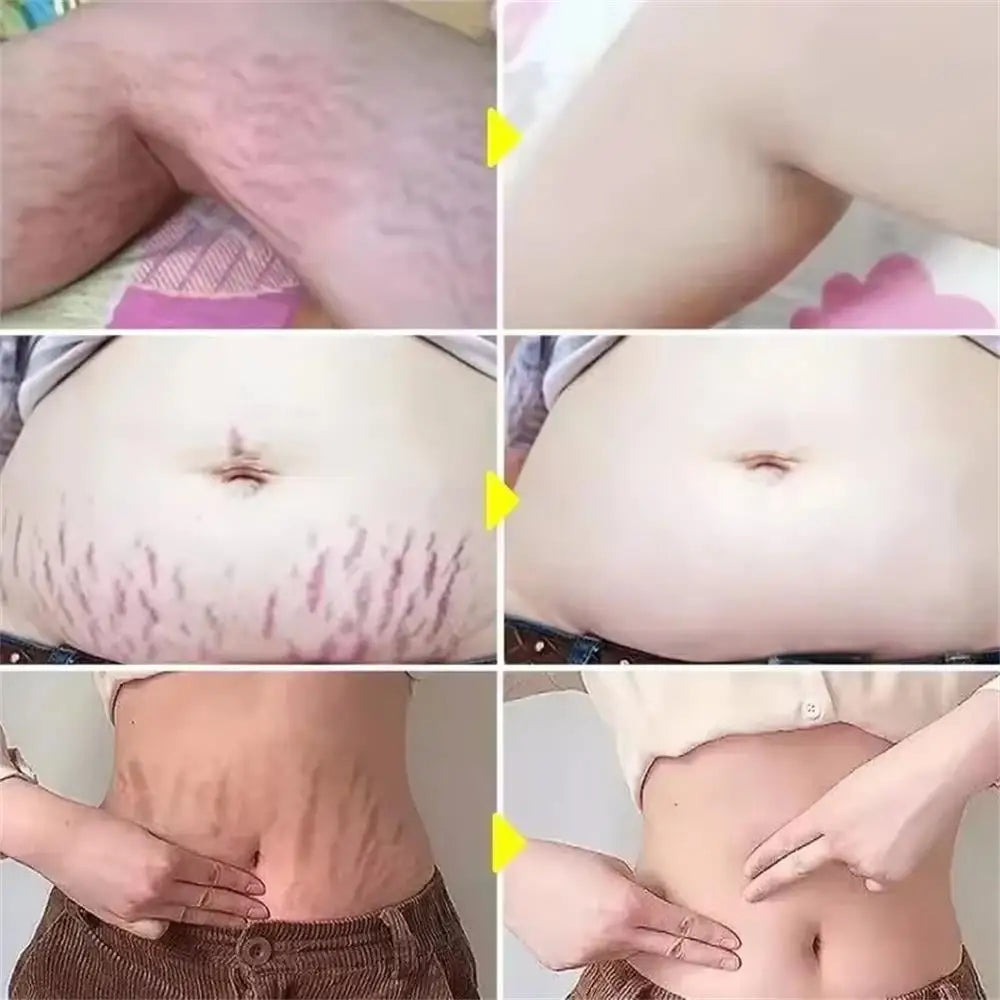 Stretch Marks Removal & Skin Firming Cream | Deep Repair Body Moisturiser | Braviixx