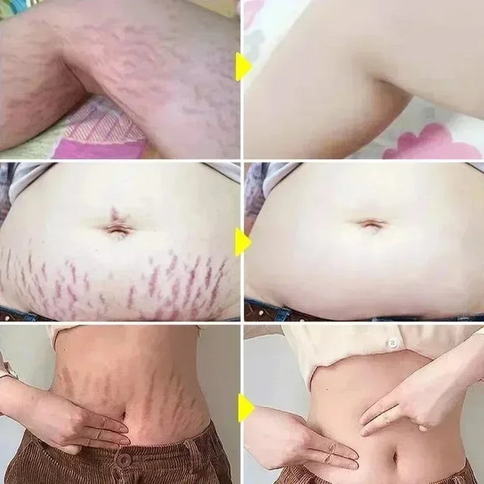 Stretch Mark Repair Cream | Helps Fade Body & Belly Marks | Braviixx