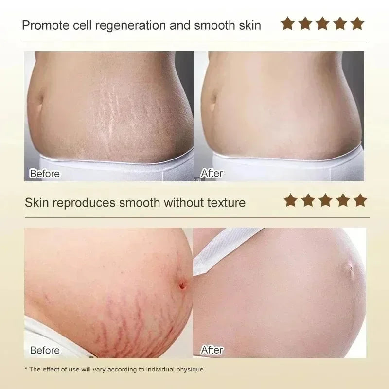 Stretch Mark Repair Cream | Helps Fade Body & Belly Marks | Braviixx