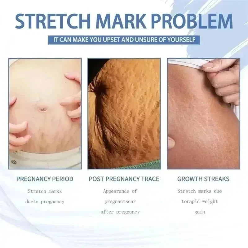 Stretch Mark Repair Cream | Helps Fade Body & Belly Marks | Braviixx