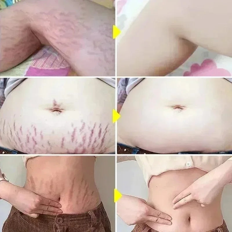 Stretch Mark Repair Cream | Helps Fade Body & Belly Marks | Braviixx